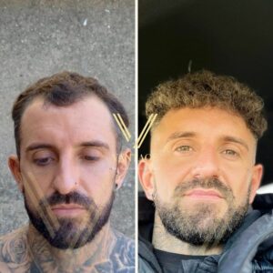 Before and After Hairline Transplant result in Turkey