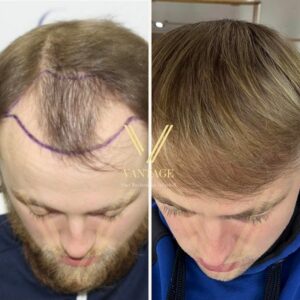 blonde hair transplant before after