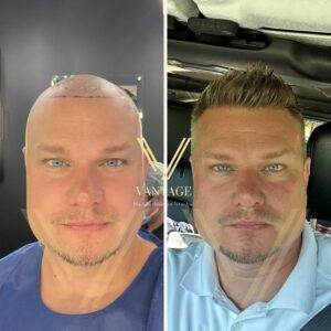 blonde hair transplant before after result