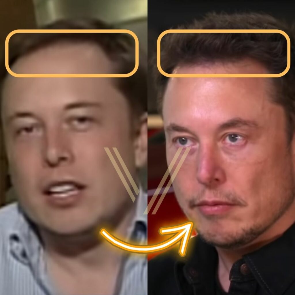 Elon Musk's Hair Transplant Before and After Transformation