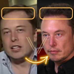 Elon musk online hair loss