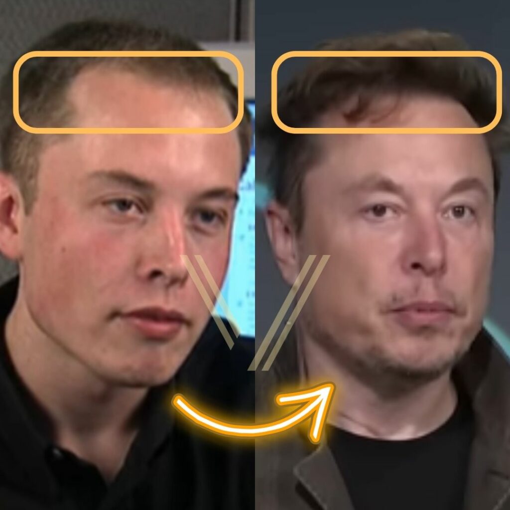 Elon Musk S Hair Transplant Before And After Transformation