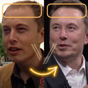 Elon Musk s Hair Transplant Before and After Transformation