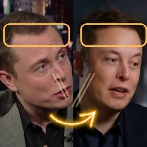 elon musk hair transplant before and after