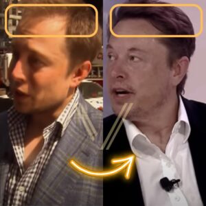 elon musk hair transplant before and after result