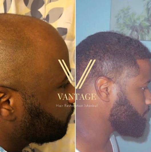 ethnic afro hair transplant in turkey before and after photo
