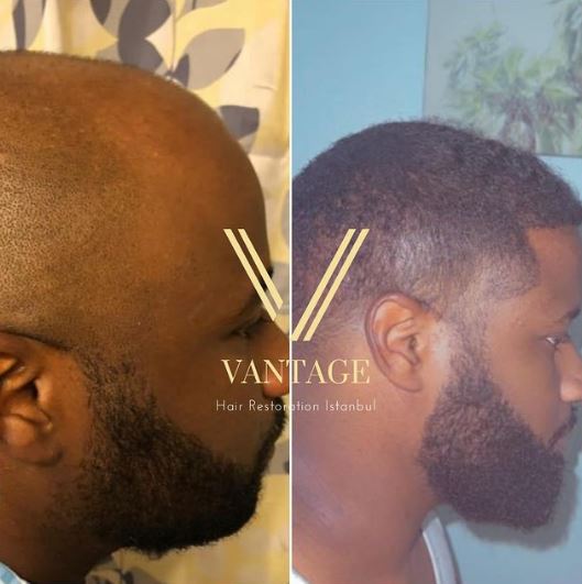 ethnic afro hair transplant before and after result