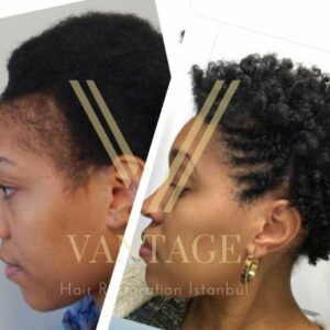 afro female hair transplant before after result in turkey