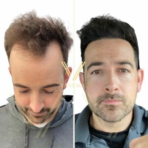 receding hairline hair transplant 3500 grafts