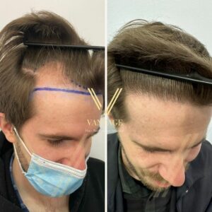 Hairline Transplant Before After result in Turkey