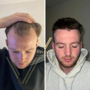 Hairline Transplant Before and After result in Turkey