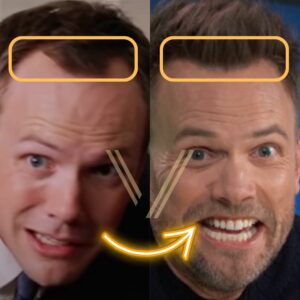 joel mchale hair transplant before and after