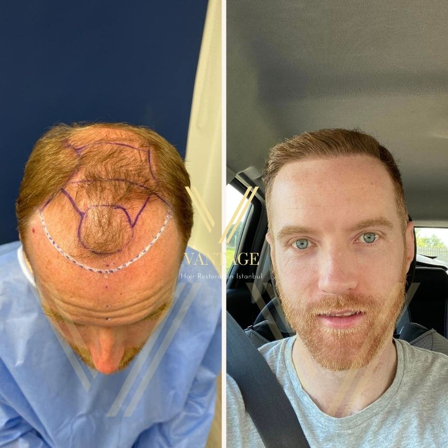 vertex hair transplant before after result