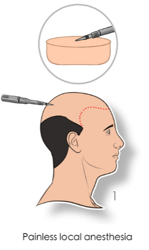 hair transplant procedure steps anesthesia