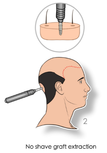 hair transplant procedure steps extraction