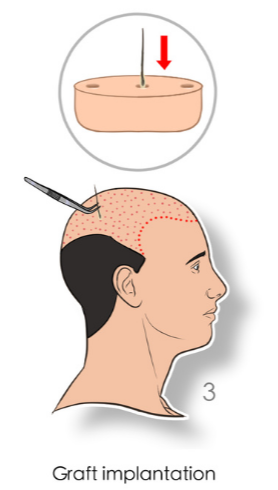 hair transplant procedure steps implantation