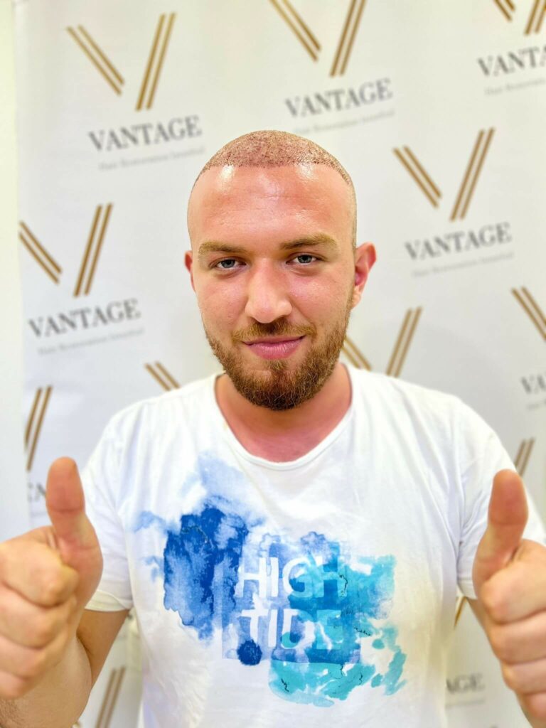 Vantage post hair transplant result