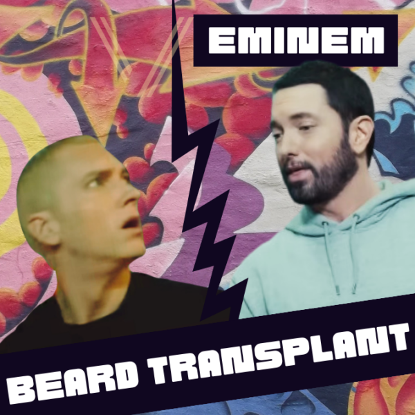 eminem beard transplant