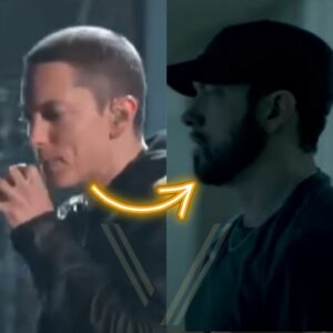 eminem beard transplant before after