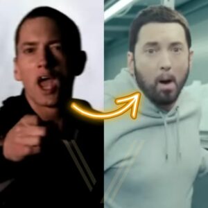 eminem beard transplant before after result