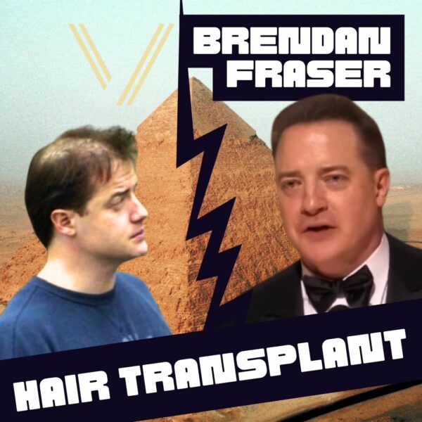 brendan fraser hair transplant analysis