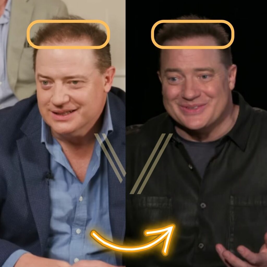 brendan fraser hair transplant before and after