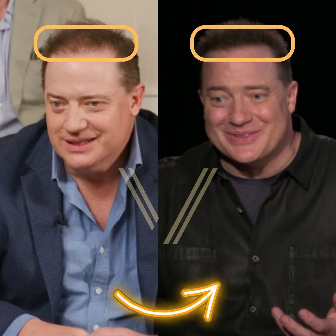 Brendan Fraser Hair Transplant: Before and After Transformation