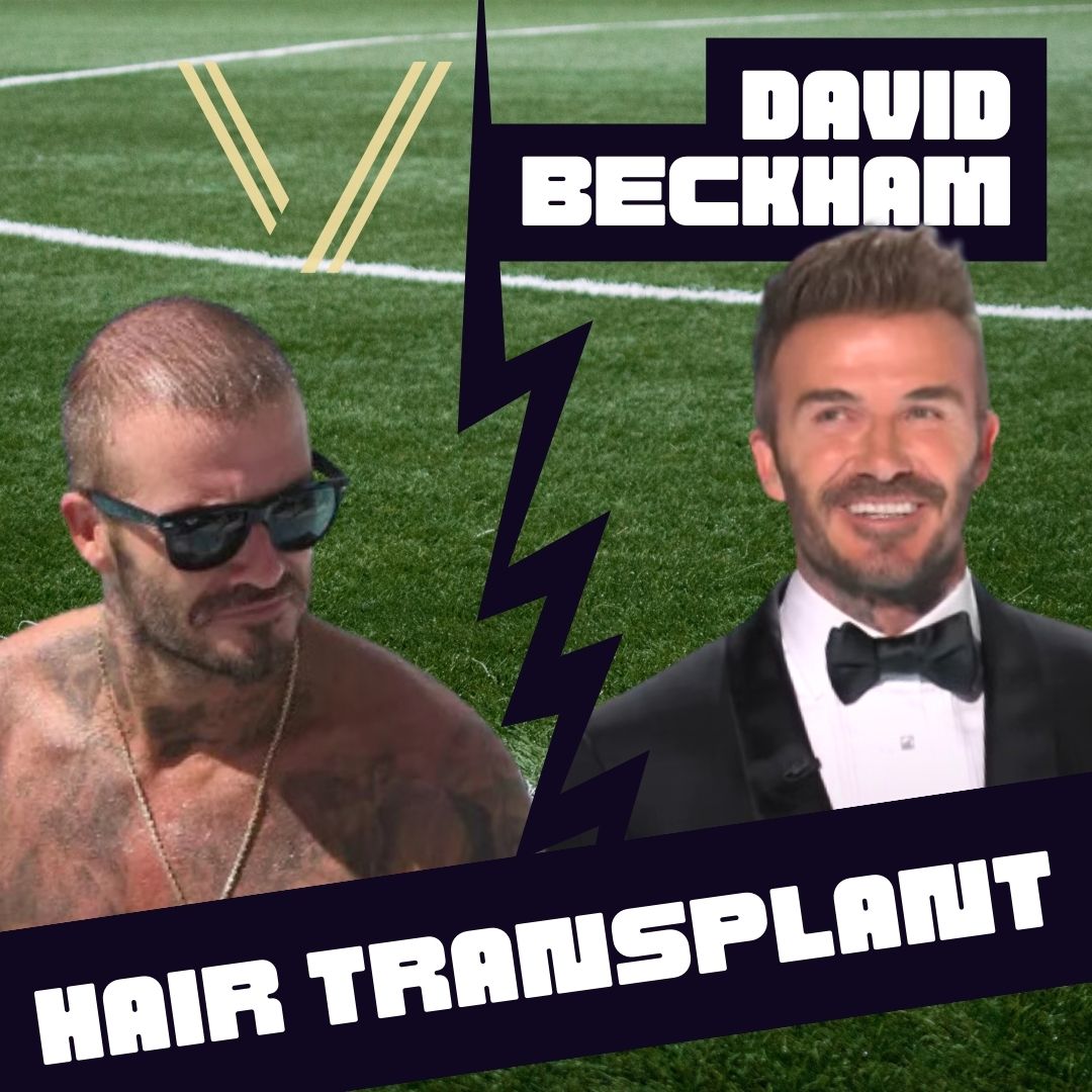 david beckham hair transplant