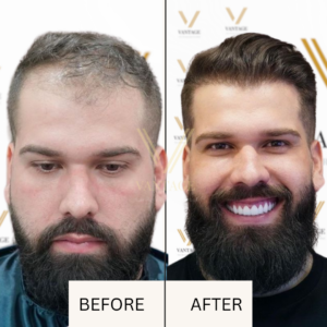 dhi hair transplant before after result
