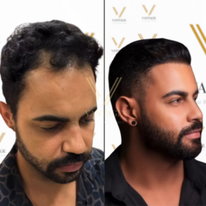 dhi hair transplant before after result vantage clinic