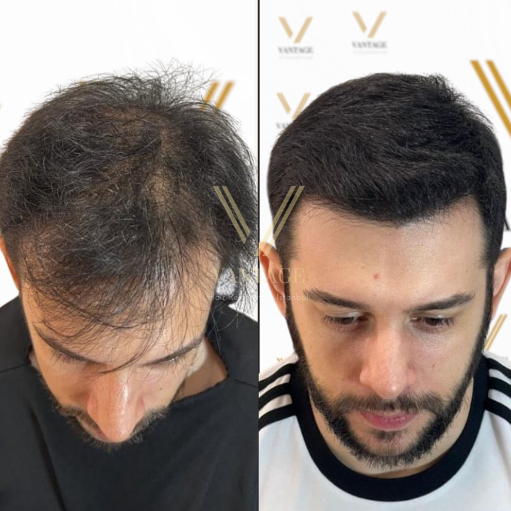 fue hair transplant before after result