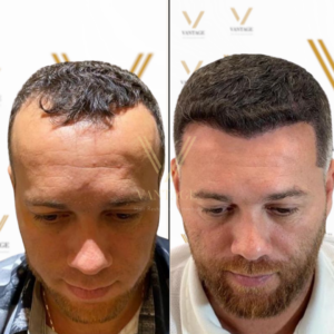 hair transplant for receding hairline before after