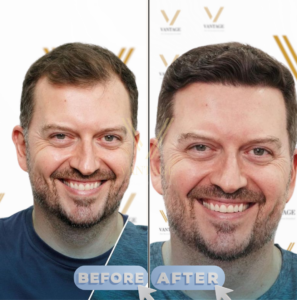 receding hairline hair transplant before after 