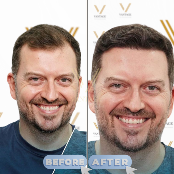 receding hairline hair transplant before after