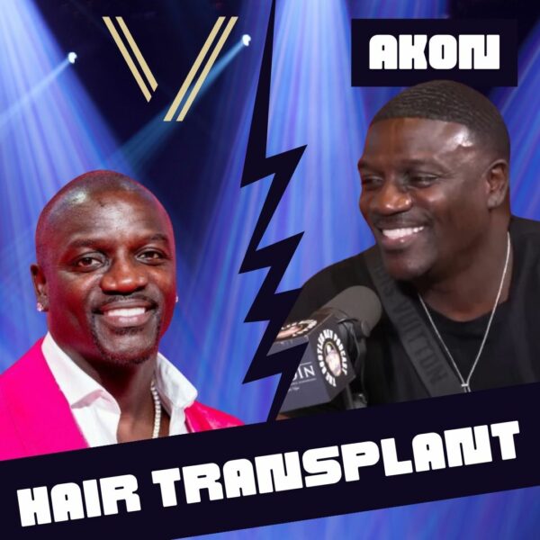 akon hair transplant