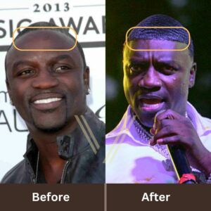 akon hair transplant before after result
