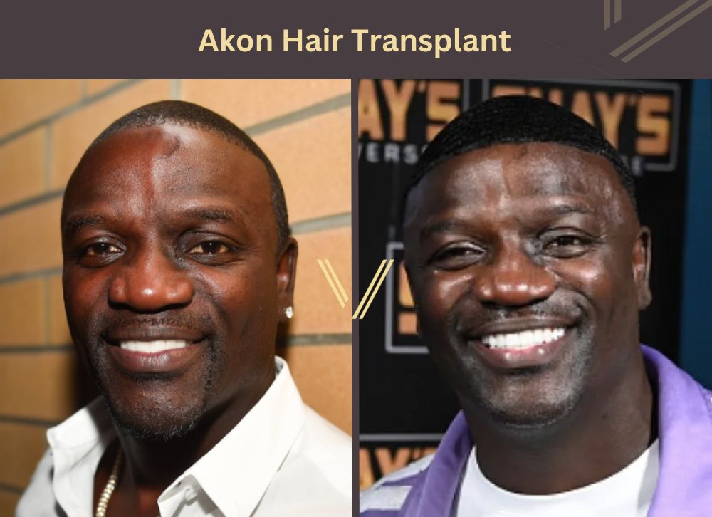 akon hair transplant before after