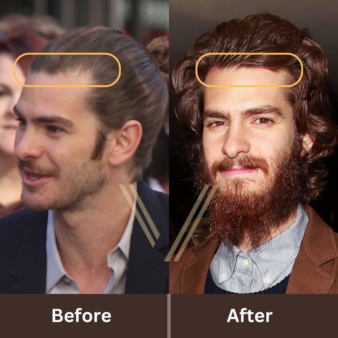 Andrew Garfields Hair Transplant Before And After Transformation