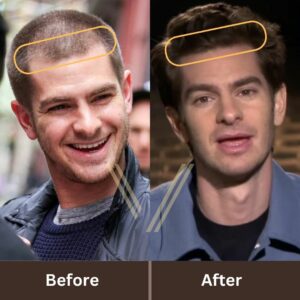 andrew garfield hair transplant before after result 