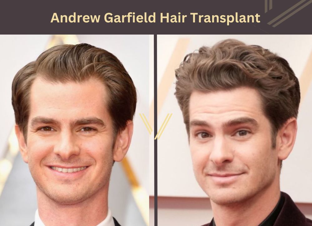 andrew garfield hair transplant before after