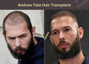 Celebrities With Hair Transplants | 95 Before & After Photos