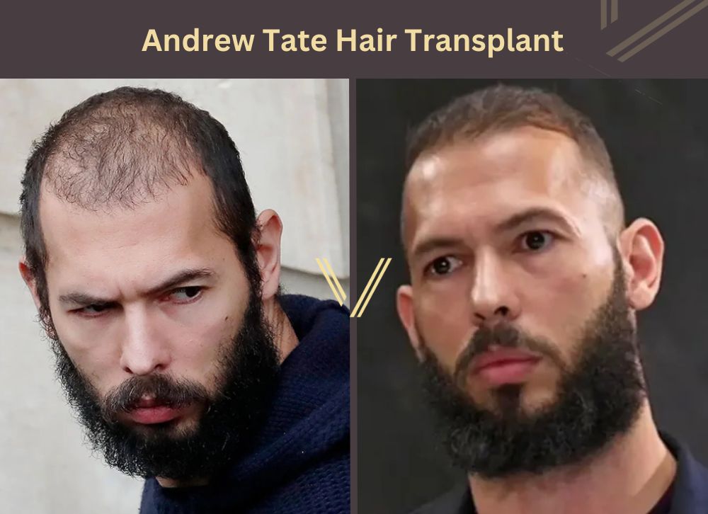 andrew tate hair transplant before after