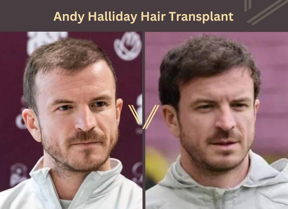 andy halliday hair transplant before after