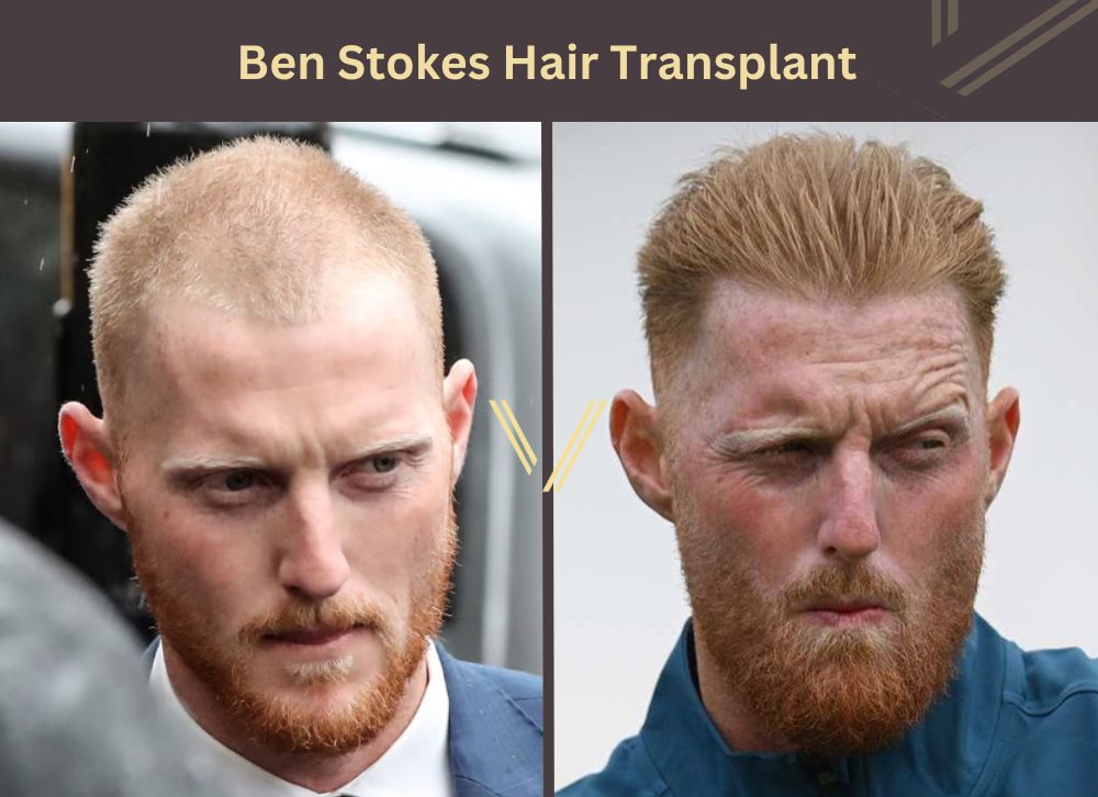 ben stokes hair transplant before after