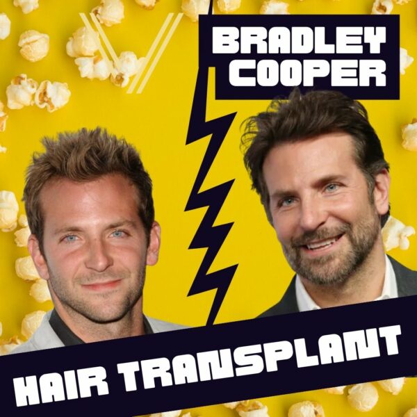 bradley cooper hair transplant