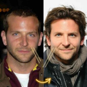 bradley cooper hair transplant before and after