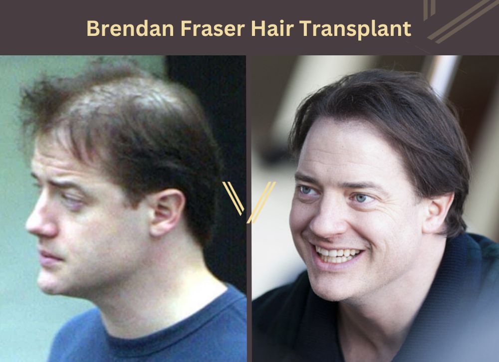 brendan fraser hair transplant before after
