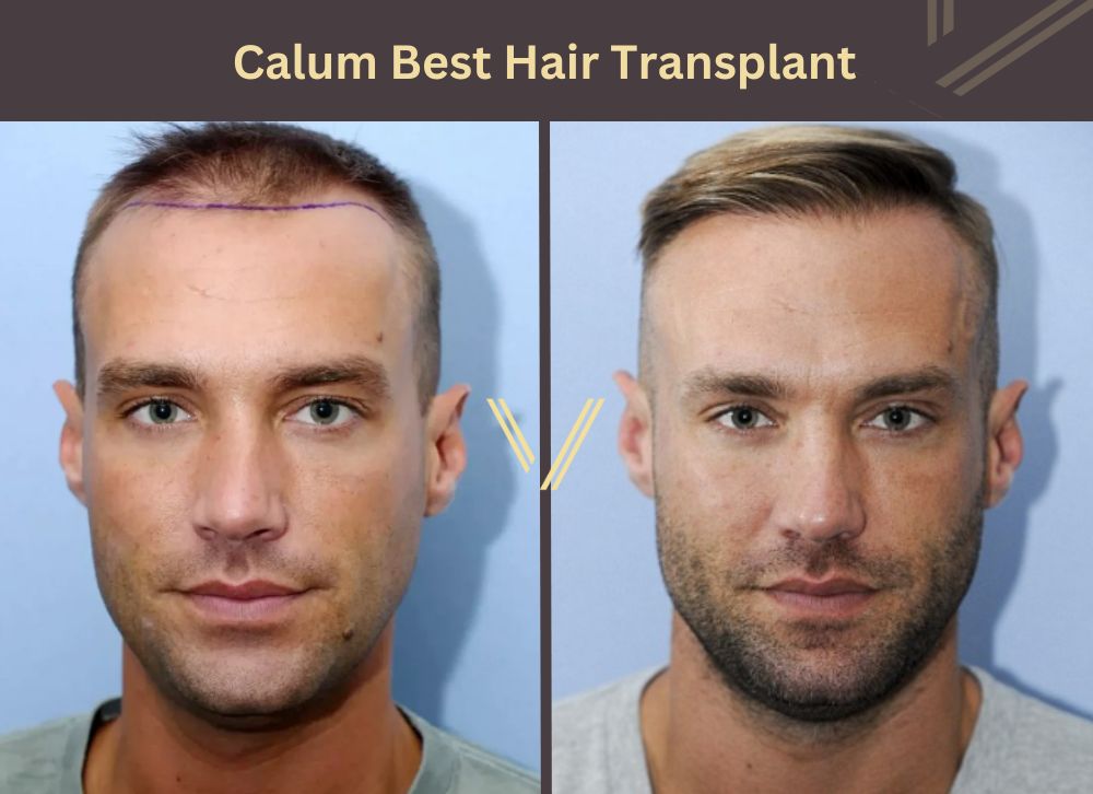 calum best hair transplant before after