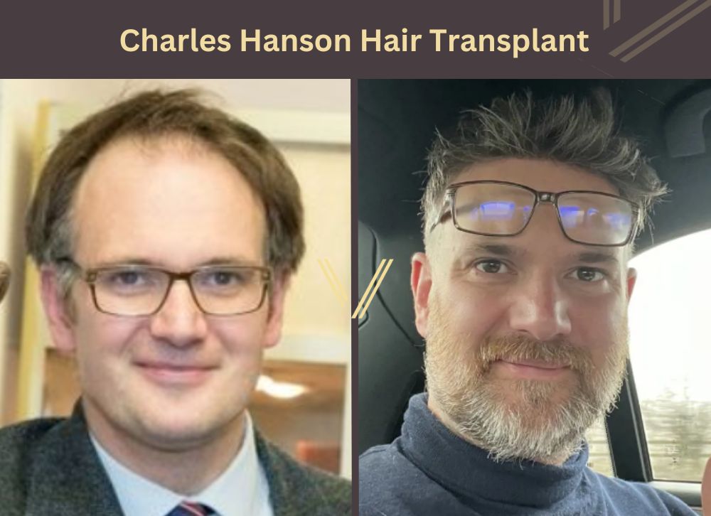 charles hanson hair transplant before after