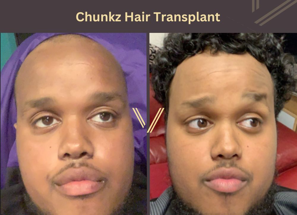 chunkz hair transplant before after